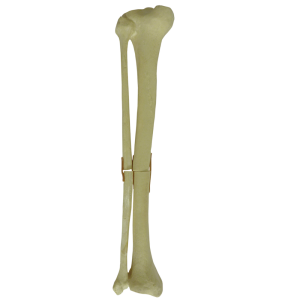 TÍBIA COM CANAL MEDULAR E ESPONJOSO COM FÍBULA - FRATURA 1 - ESQUERDA - cód. 9700